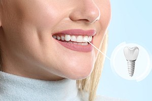 Nose-to-chin view of woman smiling with one tooth indicated as implant