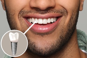 A closeup of a man’s smile that highlights his dental implant