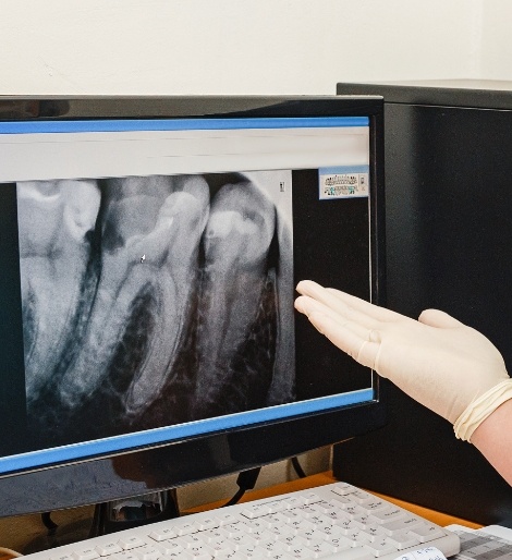 Gloved hand gesturing to a computer showing x ray of teeth