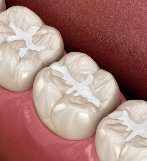 Illustrated row of teeth with white dental sealants