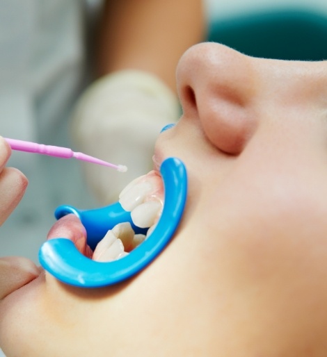 Close up of child having fluoride applied to their teeth by dentist