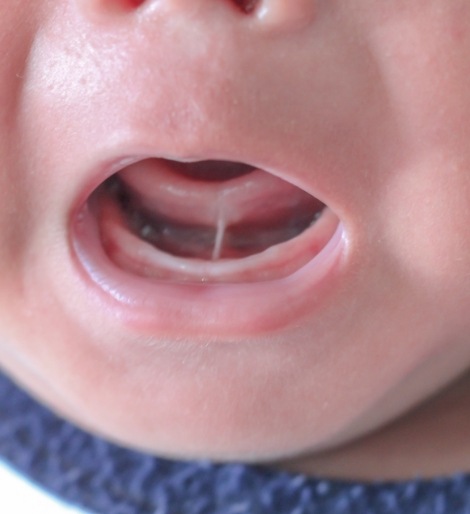 Close up of a baby with a tongue tie opening their mouth