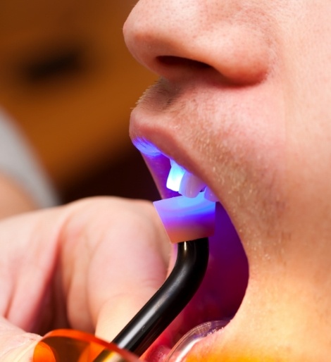 Close up of dental patient having their upper front tooth treated