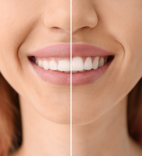 Close up of woman smiling before and after gummy smile correction