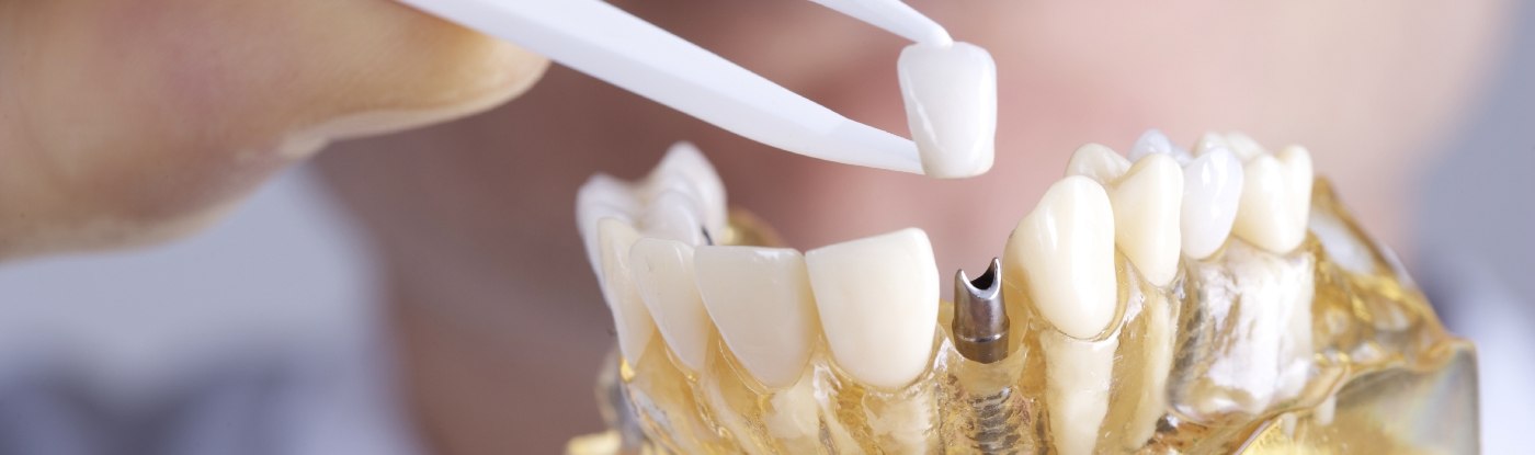 Dentist placing a crown on a dental implant in Allen in a model of the mouth