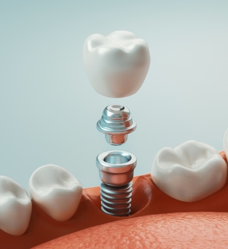 Illustrated dental crown being placed on top of a dental implant