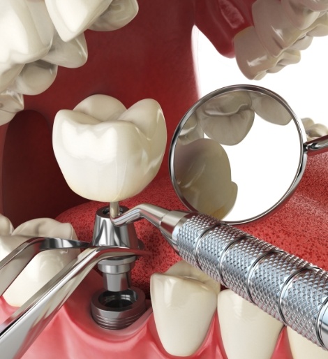 Illustrated dental implant replacing a missing lower tooth