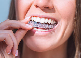 Close up of a person placing a clear aligner over their teeth