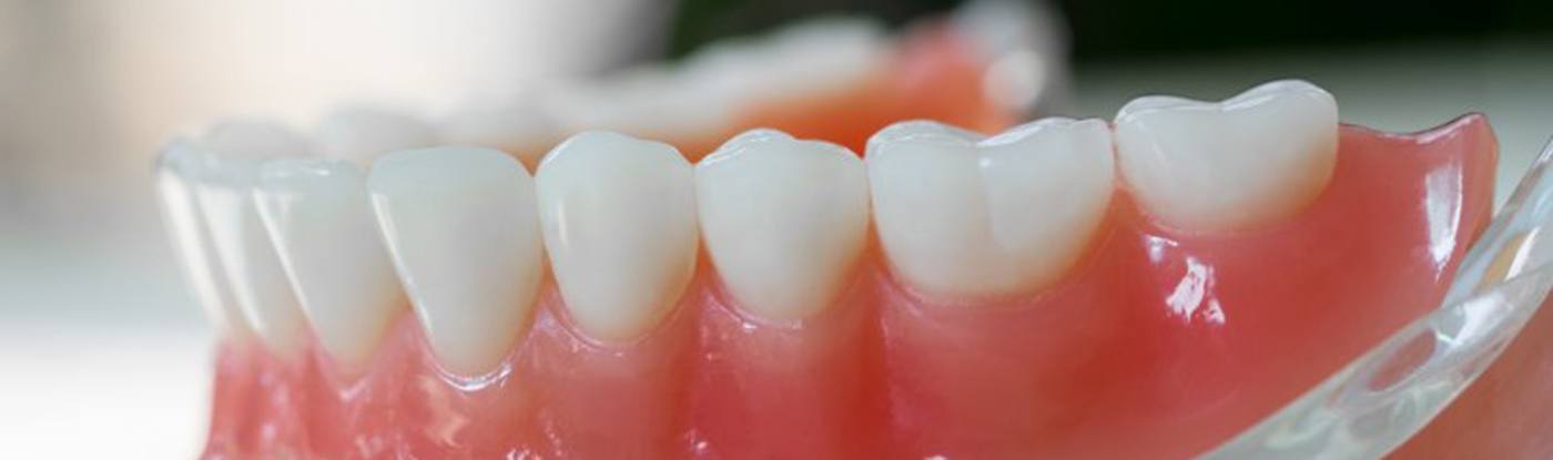 an example of an implant denture