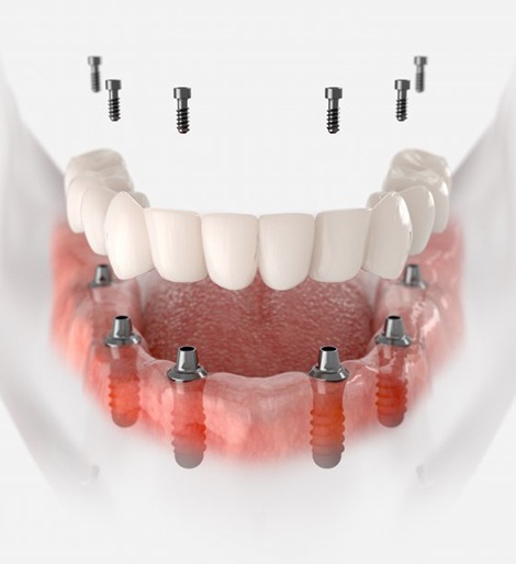 a 3D illustration of an implant denture