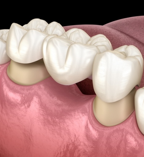 Illustrated dental bridge being fitted over two teeth to fill the space between them