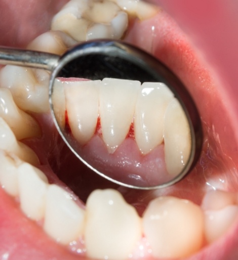 Close up of a dental mirror inside of a mouth