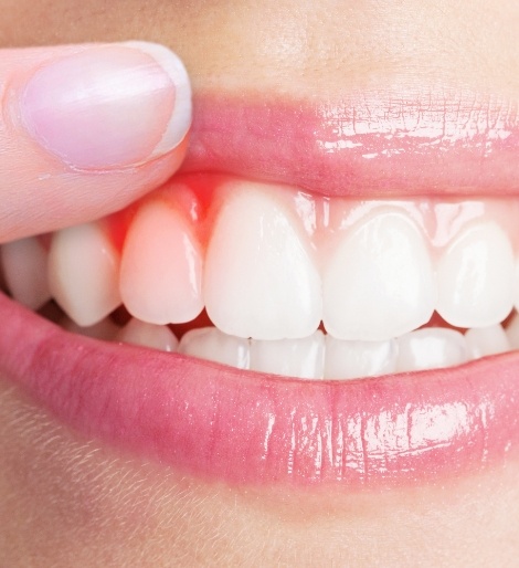 Close up of a person pointing to a red spot in their gums