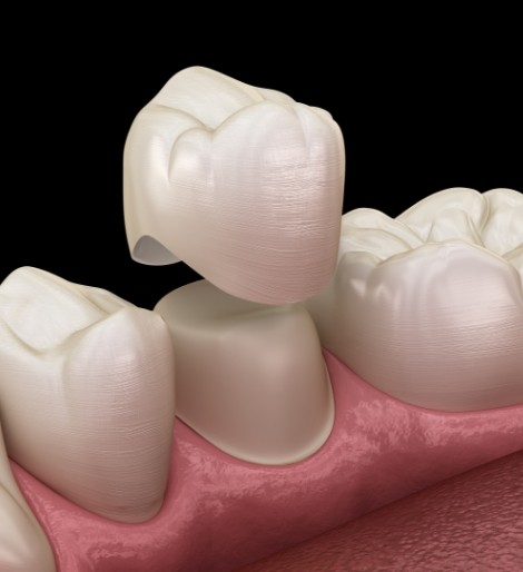 Illustration of a dental crown being fitted over a tooth