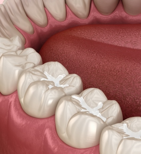 Illustrated row of teeth with white fillings