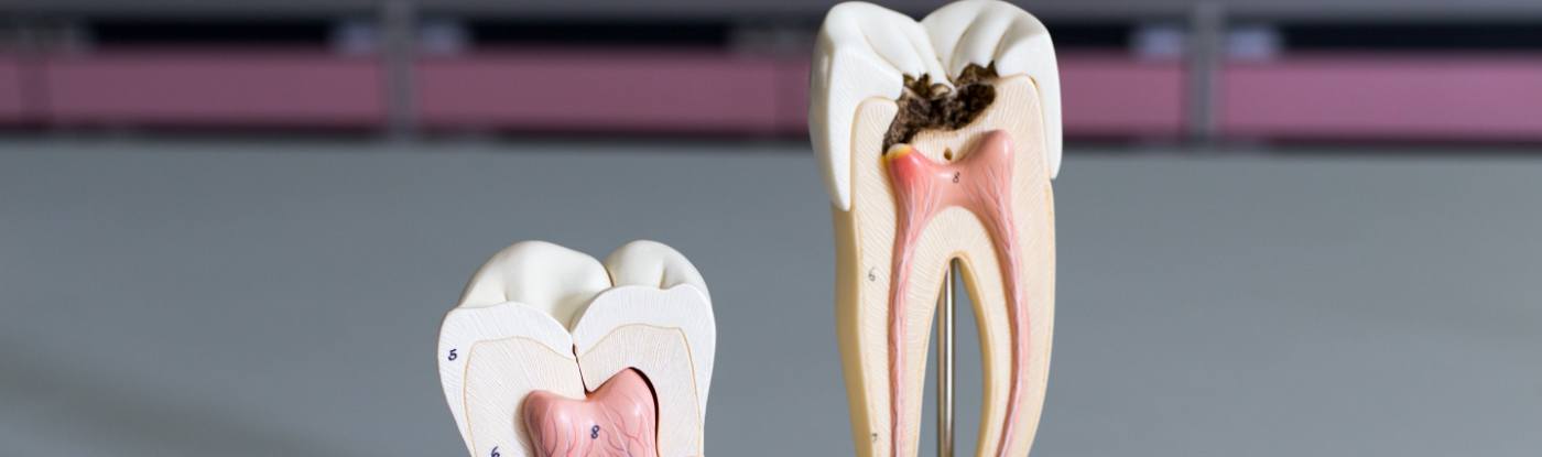 Model of a decayed tooth that needs root canal treatment