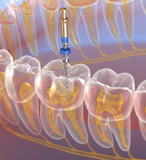 Illustrated dental instrument treating the inside of a tooth