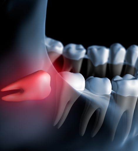 Illustration of an impacted wisdom tooth pressing against the adjacent tooth